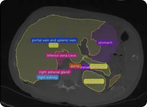 Volumetric Segmentation|
Segment structures or objects from volumetric medical data, such as CT or MRI scans
